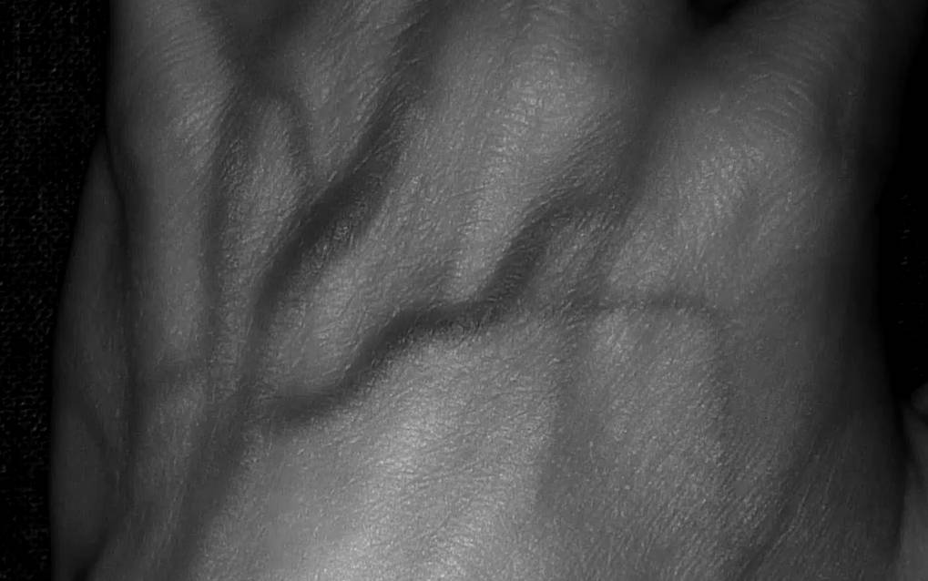 The high definition image of the vein finder device makes venipuncture access very easy and productive for nurses