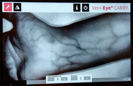 The medical Vein viewer Devices help vein access and venipuncture for a child easy for nurses